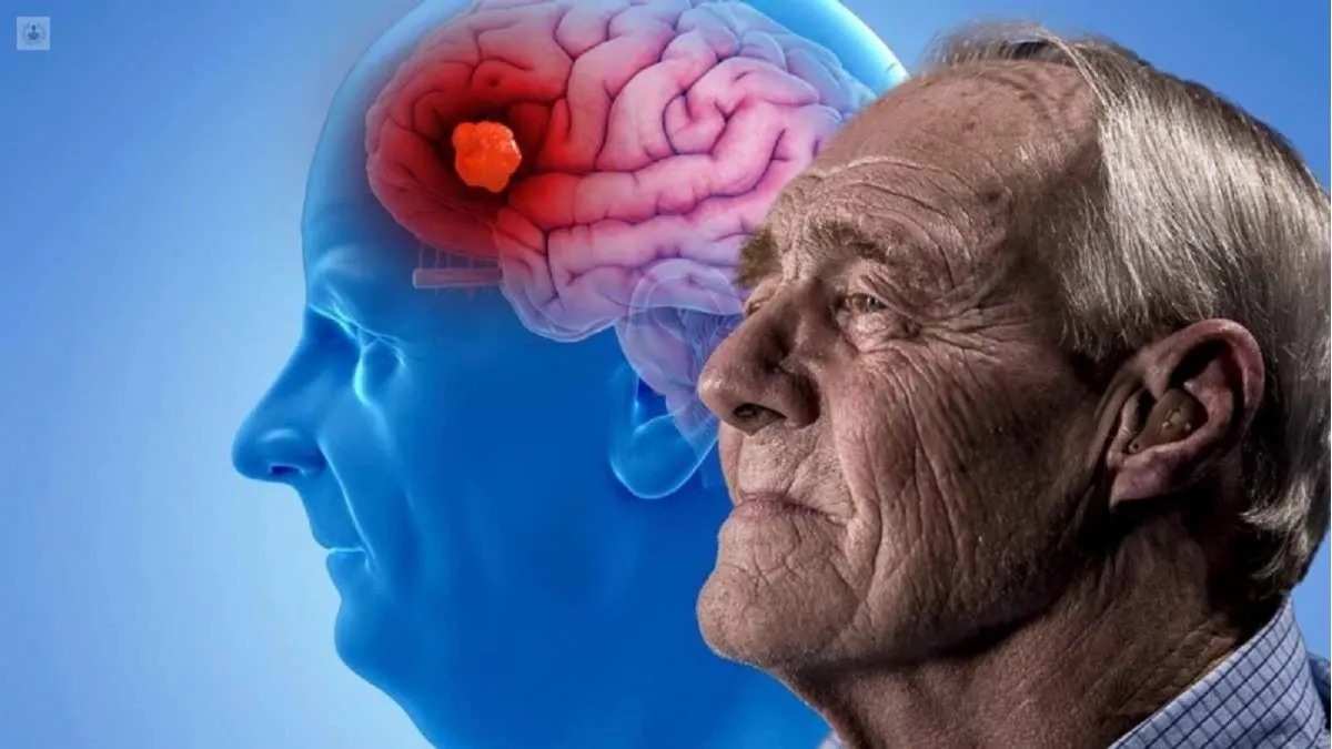 Análisis de sangre para Alzheimer detectó 90% de casos precoces