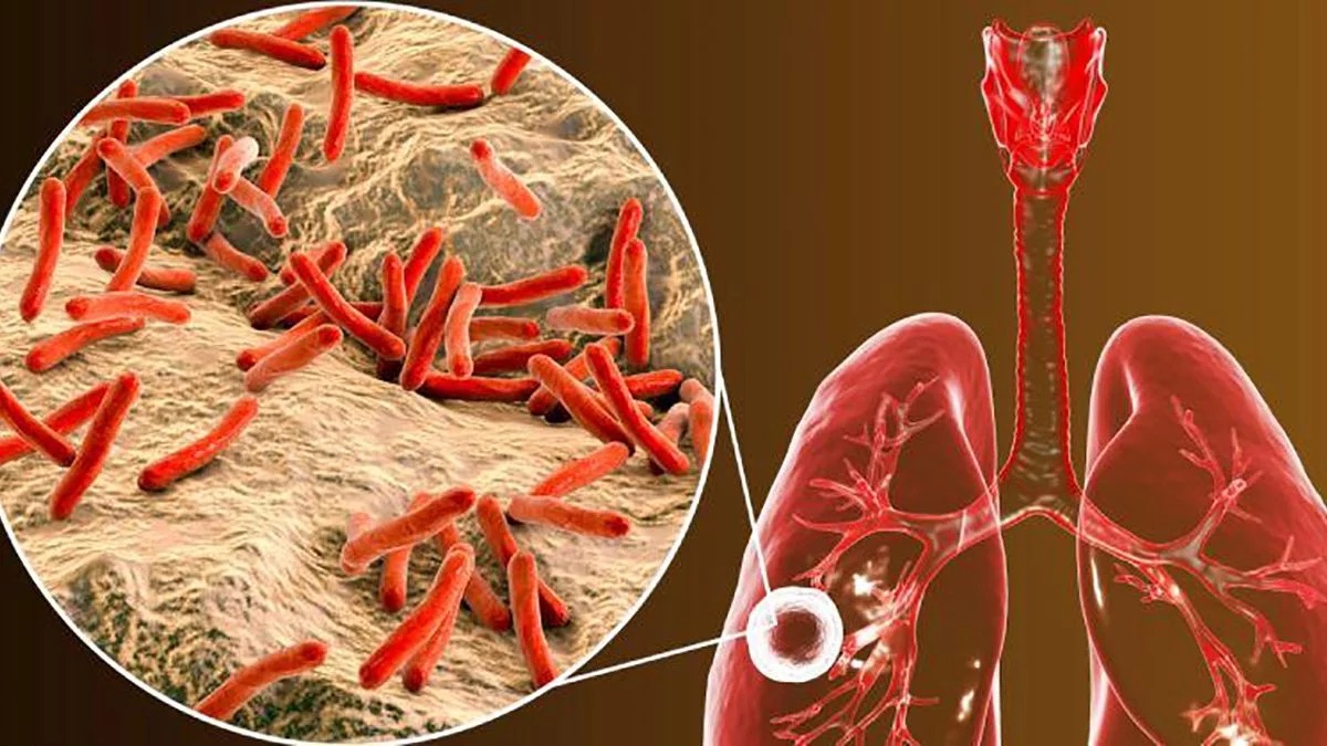 Once provincias reportaron los mayores casos de tuberculosis en el país